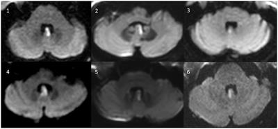 Video head impulse testing in patients with isolated (hemi)nodular infarction